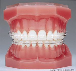 Appareil ceramique - Orthodontiste Haguenau