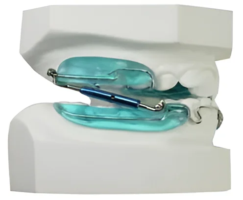 exemple de pose de traitement dentaire de type "propulseur mandibulaire" de couleur bleue